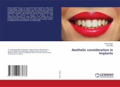 Aesthetic consideration in Implants
