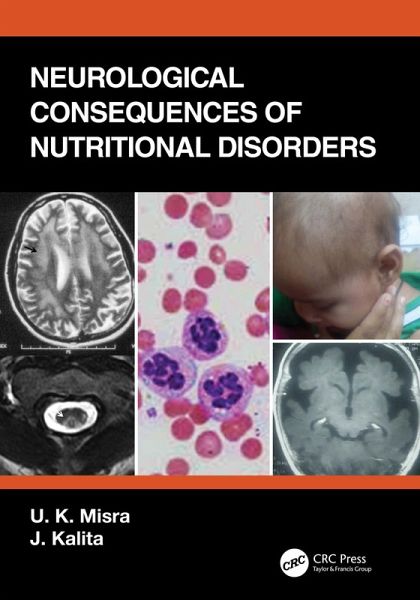 Neurological Consequences of Nutritional Disorders (eBook, ePUB) Neurological Consequences of Nutritional Disorders (eBook, ePUB)