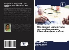 Naklonnye implantaty dlq reabilitacii Edentulous Jaws - obzor - Venkat, Asweshq; V, Amalorpawam; Mithran, Akash