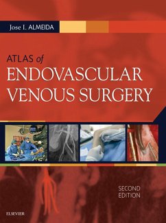 Atlas of Endovascular Venous Surgery E-Book (eBook, ePUB) - Almeida, Jose