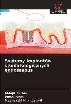 Systemy implantów stomatologicznych endosseous - Sethia, Abhijit; Punia, Vikas; Khandelwal, Meenakshi