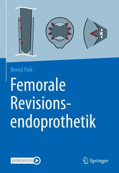 Femorale Revisionsendoprothetik (eBook, PDF) - Fink, Bernd