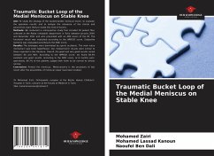 Traumatic Bucket Loop of the Medial Meniscus on Stable Knee - Zairi, Mohamed;Kanoun, Mohamed Lassad;Ben Dali, Naoufel