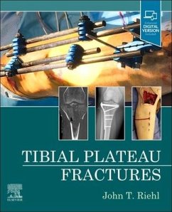 Tibial Plateau Fractures - Riehl, John