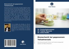 Biomechanik bei gegossenem Teilzahnersatz - Bahiramwar, Dr. Suyog;Mowade, Dr. Tushar;Radke, Dr. Usha