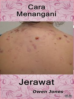 Cara Menangani Jerawat (eBook, ePUB) - Jones, Owen