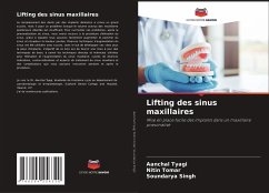 Lifting des sinus maxillaires - Tyagi, Aanchal;Tomar, Nitin;Singh, Soundarya