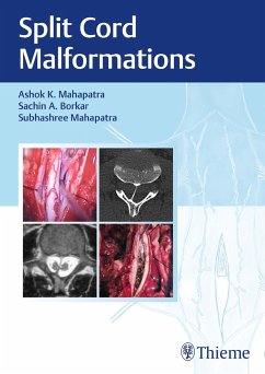 Split Cord Malformations - Mahapatra, Ashok;Borkar, Sachin;Mahapatra, Subhashree