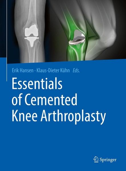 Essentials of Cemented Knee Arthroplasty (eBook, PDF) Essentials of Cemented Knee Arthroplasty (eBook, PDF)