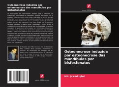 Osteonecrose induzida por osteonecrose das mandíbulas por bisfosfonatos - Iqbal, Md. Jawed