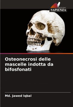 Osteonecrosi delle mascelle indotta da bifosfonati - Iqbal, Md. Jawed