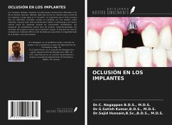 OCLUSIÓN EN LOS IMPLANTES - B. D. S., M. D. S.; Kumar, B. D. S.; Hussain, B. Sc.