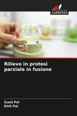 Rilievo in protesi parziale in fusione