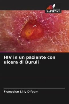 HIV in un paziente con ulcera di Buruli - Difoum, Françoise Lilly