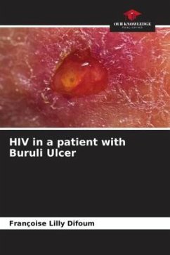 HIV in a patient with Buruli Ulcer - Difoum, Françoise Lilly