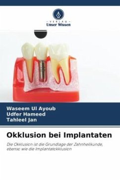 Okklusion bei Implantaten - Ul Ayoub, Waseem;Hameed, Udfer;Jan, Tahleel