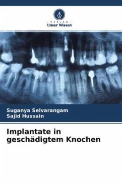 Implantate in geschädigtem Knochen - Selvarangam, Suganya;Hussain, Sajid