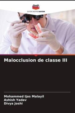 Malocclusion de classe III - Malayil, Mohammed Ijas;Yadav, Ashish;Joshi, Divya