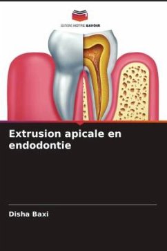 Extrusion apicale en endodontie - Baxi, Disha