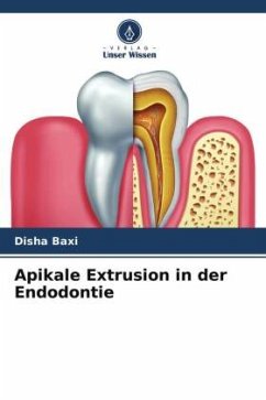 Apikale Extrusion in der Endodontie - Baxi, Disha