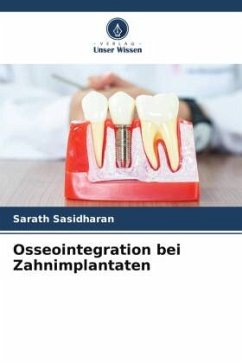 Osseointegration bei Zahnimplantaten - Sasidharan, Sarath