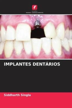 IMPLANTES DENTÁRIOS - Singla, Siddharth