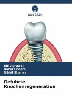 Geführte Knochenregeneration - Agrawal, Eiti;Chopra, Rahul;Sharma, Nikhil