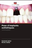 Pose d'implants esthétiques