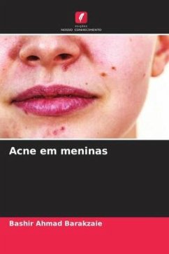 Acne em meninas - Barakzaie, Bashir Ahmad