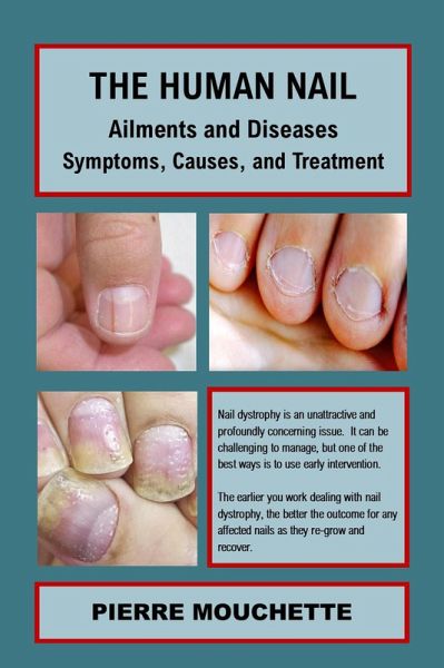 THE HUMAN NAIL - Ailments and Diseases (eBook, ePUB) THE HUMAN NAIL - Ailments and Diseases (eBook, ePUB)
