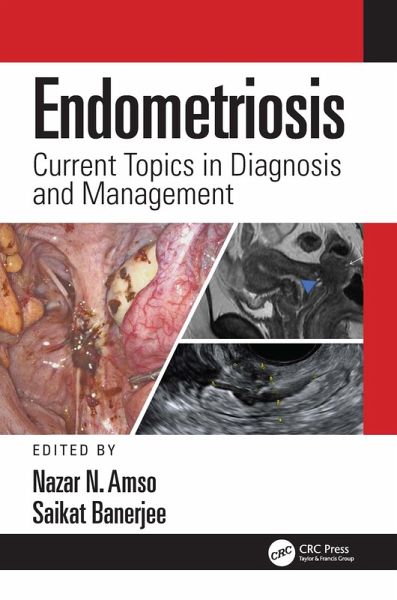 Endometriosis (eBook, PDF)