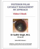 Posterior Polar Cataract Management: My Approach (2022, #1) (eBook, ePUB)
