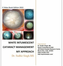 White Intumescent Cataract Management: My Approach (2022, #1) (eBook, ePUB) - Singh, Sudhir