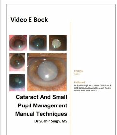Cataract And Small Pupil Management Manual Techniques (2022, #1) (eBook, ePUB) - Singh, Sudhir