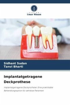 Implantatgetragene Deckprothese - Sudan, Sidhant;Bharti, Tanvi