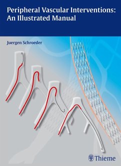 Peripheral Vascular Interventions: An Illustrated Manual (eBook, PDF) - Schröder, Jürgen