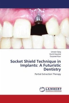 Socket Shield Technique in Implants: A Futuristic Dentistry