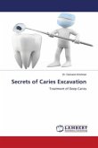Secrets of Caries Excavation