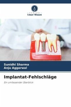 Implantat-Fehlschläge - Sharma, Sunidhi;Aggarwal, Anju