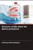 Gravure acide dans les dents primaires