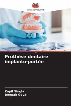 Prothèse dentaire implanto-portée - Singla, Kapil;Goyal, Deepak