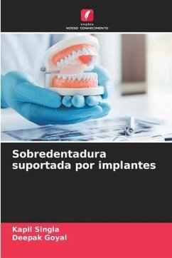 Sobredentadura suportada por implantes - Singla, Kapil;Goyal, Deepak