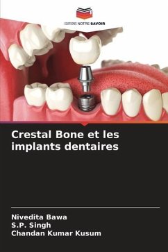 Crestal Bone et les implants dentaires - Bawa, Nivedita;Singh, S. P.;Kumar Kusum, Chandan