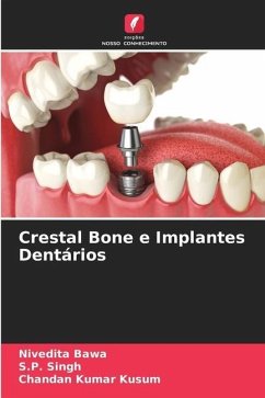Crestal Bone e Implantes Dentários - Bawa, Nivedita;Singh, S. P.;Kumar Kusum, Chandan
