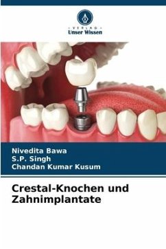 Crestal-Knochen und Zahnimplantate - Bawa, Nivedita;Singh, S. P.;Kumar Kusum, Chandan