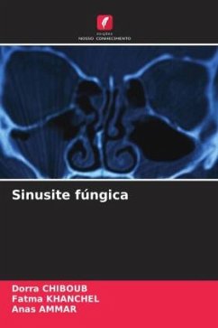 Sinusite fúngica - CHIBOUB, Dorra;khanchel, Fatma;AMMAR, Anas