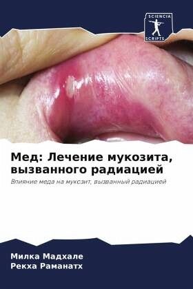 Med: Lechenie mukozita, wyzwannogo radiaciej Med: Lechenie mukozita, wyzwannogo radiaciej
