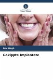 Gekippte Implantate