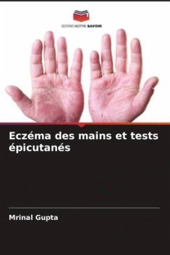 Eczéma des mains et tests épicutanés - Gupta, Mrinal