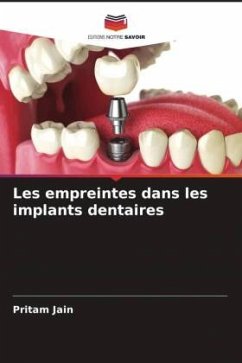 Les empreintes dans les implants dentaires - Jain, Pritam